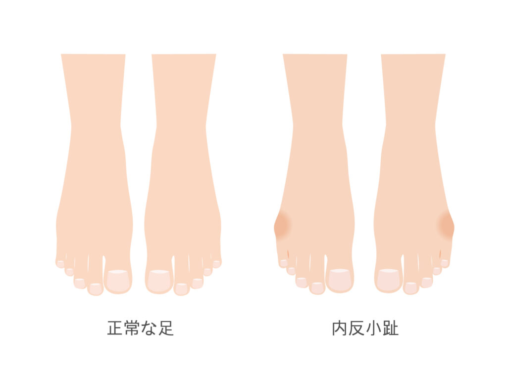 正常な足指と内反小趾の比較をするイラスト