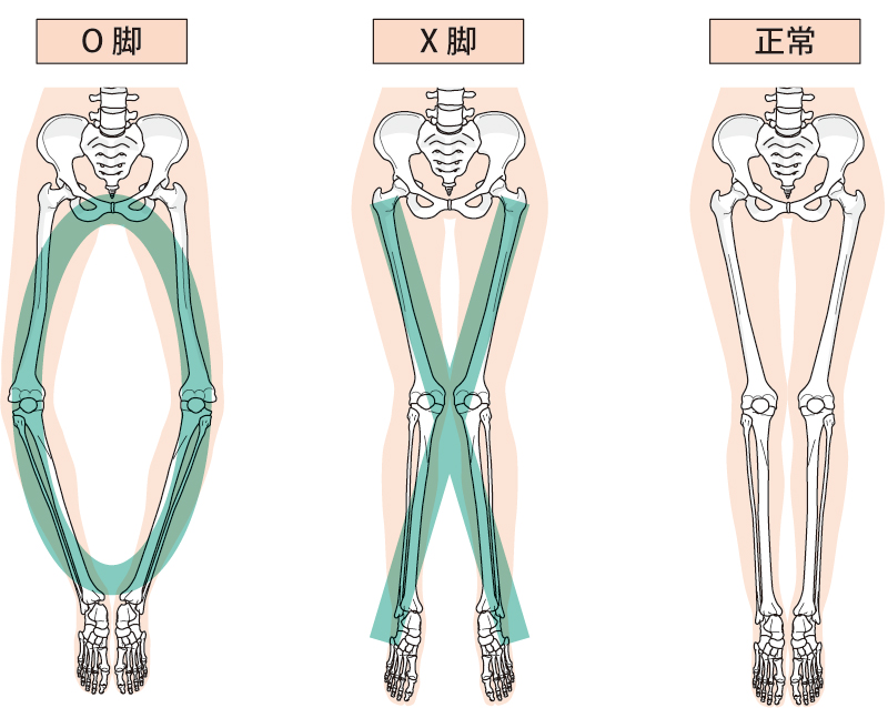 直立して膝同士がつかないO脚、膝はつくが内くるぶしがつかないX脚。どちらも将来、別の疾患のリスクとなります。