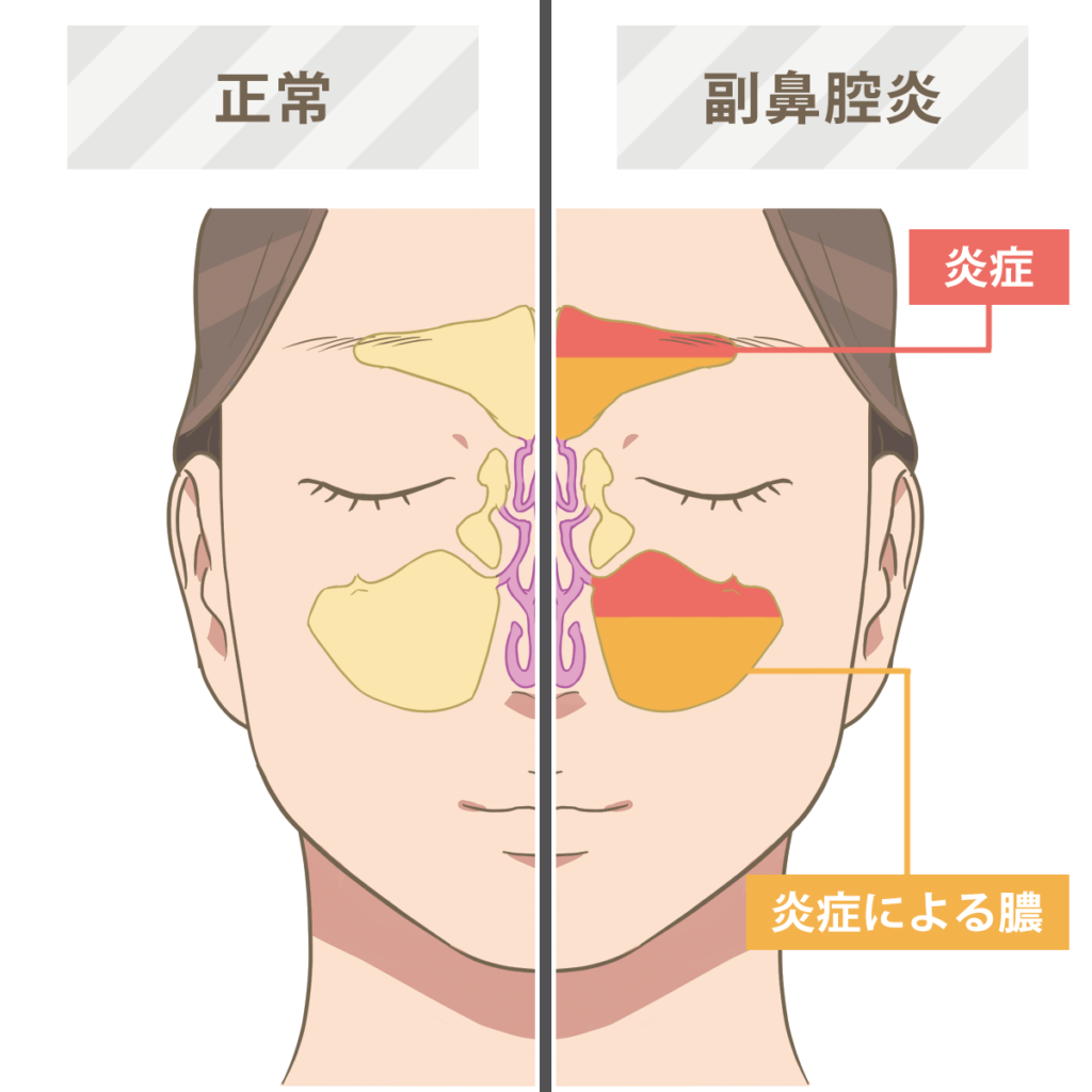 慢性的な鼻づまりの原因として副鼻腔炎の可能性もあります