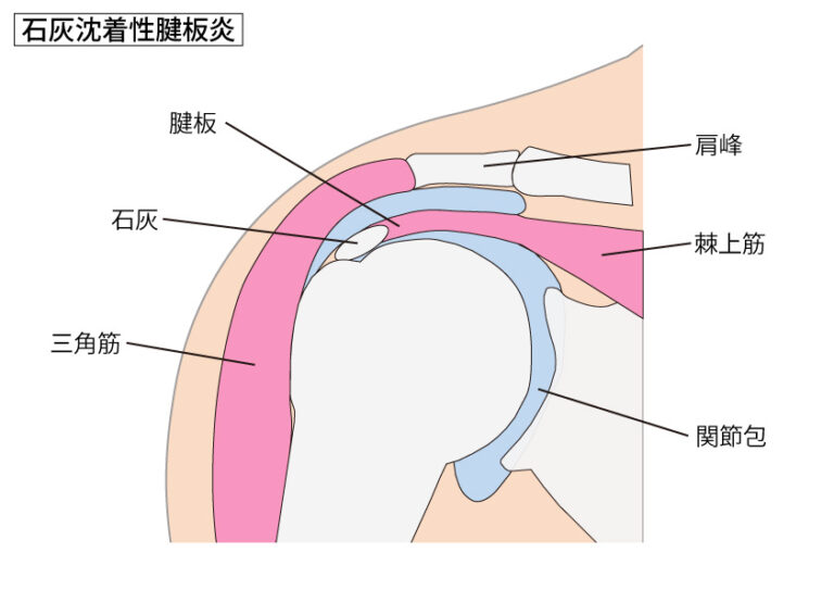 石灰沈着性腱板炎の専門施術｜神戸市灘区の鍼灸整骨院｜いわや鍼灸整骨院｜岩屋駅徒歩1分